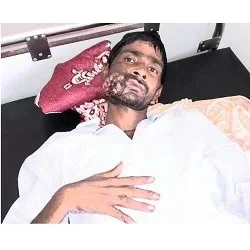 paralysis
